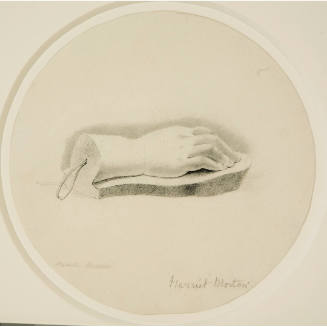 Drawing of Right Hand Plaster Cast